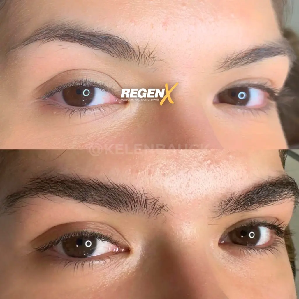 Resultat-reconstruction-sourcils