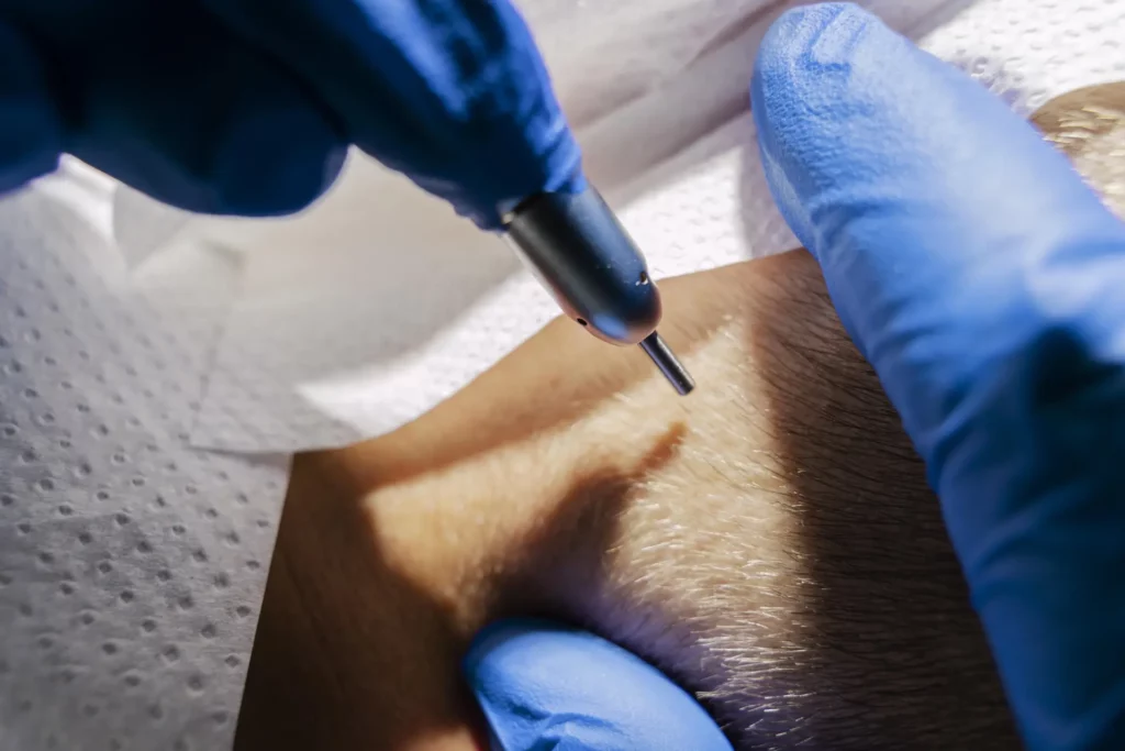 Tricopigmentation